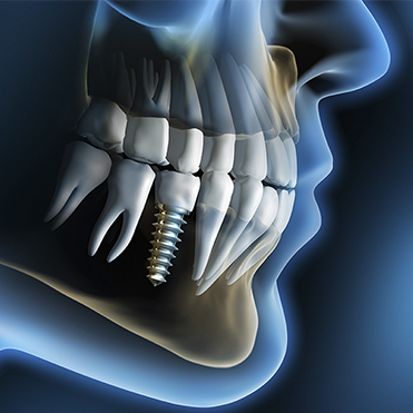 Con l'impianto dentale applicato nella clinica dentale Gran Turismo Dentale, è possibile sostituire un dente singolo, un gruppo di denti ravvicinati o un’intera arcata dentaria.