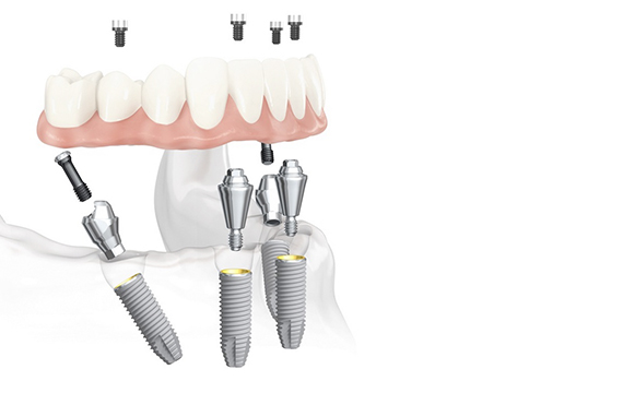 All-on-4 Impianto: 4 impianti dentali; 4 abutments; 12 denti provvisori (mobili); 12 corone in resina (denti fissi). Grand Turismo Dentale