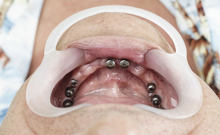Preparazione della base nella bocca del paziente per il fissaggio dell'impianto All-on-six nella grande clinica odontoiatrica Turismo Dentale di Chisinau