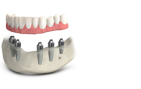 All-on-6 Impianto: 6 impianti dentali, 6 abutments, 12 denti provvisori (mobili), 12 corone in resina (denti fissi). Grand Turismo Dentale