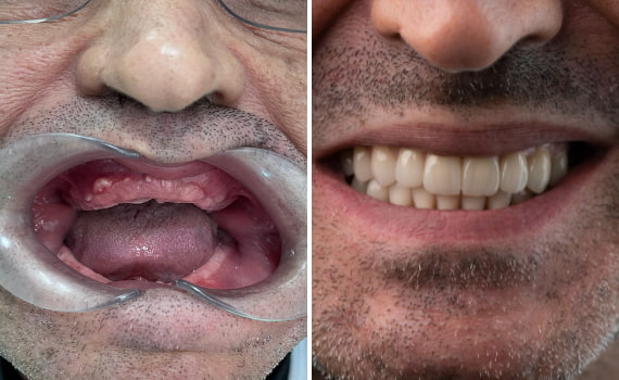 Pulizia dei Denti Professional  ha rimosso anni di scolorimento da tè, caffè e tabacco dai denti di questo paziente nella clinica dentale Grand Turismo Dentale di Chișinău