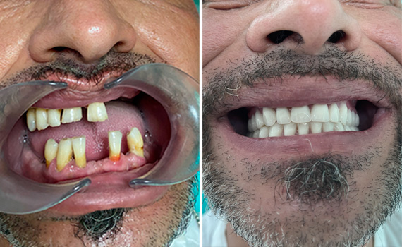 Le faccette in ceramica  nella clinica dentale Grand Turismo Dentale di Chisinau sono le più utilizzate grazie alla resistenza ottimale del materiale, e al fatto non trascurabile che si tratta di restauri adesivi minimamente invasivi.