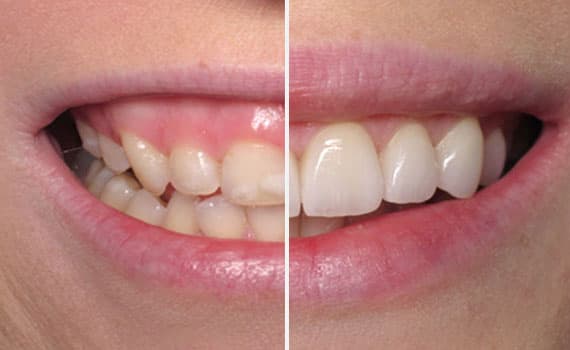 Le faccette in ceramica nella clinica dentale Grand Turismo Dentale di Chisinau sono le più utilizzate grazie alla resistenza ottimale del materiale, e al fatto non trascurabile che si tratta di restauri adesivi minimamente invasivi.