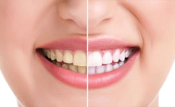 Pulizia dei Denti Professional ha rimosso anni di scolorimento da tè, caffè e tabacco dai denti di questo paziente nella clinica dentale Grand Turismo Dentale di Chișinău