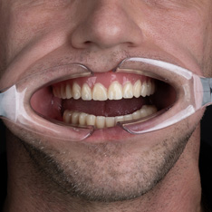 La giovane donna con bei denti dritti sorride dopo aver indossato le apparecchi ortodontici
