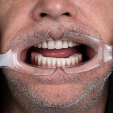 Donna e uomo che sorridono con denti bianchi e lucenti dopo la procedura professionale di pulizia dei denti eseguita nella clinica sotmatologica del Grand Turismo Dentale in Moldavia
