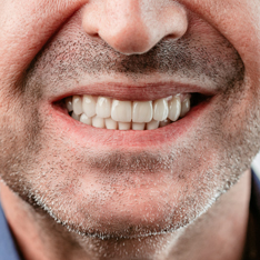 Il paziente della clinica odontoiatrica Grand Turismo dimostra il bellissimo sorriso dopo l'installazione delle faccette dentali