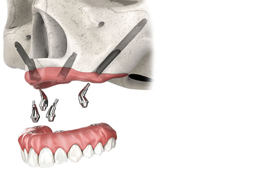 Impianti Zigomatici: 2 impianti zigomatici, 2 abutments zigomatici, 12 denti provvisori(fissi immediato); Anestesia generale. Grand Turismo Dentale