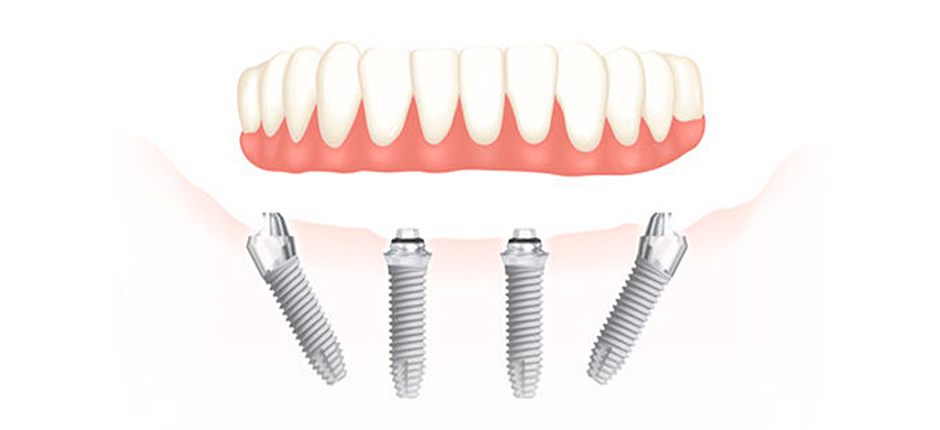 L’implantologia All on four è una tecnica odontoiatrica moderna che consente di riabilitare intere arcate dentali danneggiate e o molto compromesse, o addirittura prive di denti.Approfitta dell'offerta a prezzo ridotto per questo impianto nella clinica dentale Grand Turismo Dentale
