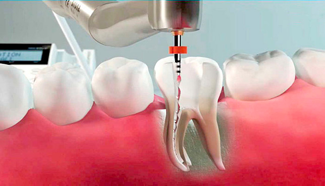 La cura canalare realizzato con strumenti e materiali all'avanguardia nella clinica dentale Grand Turismo Dentale