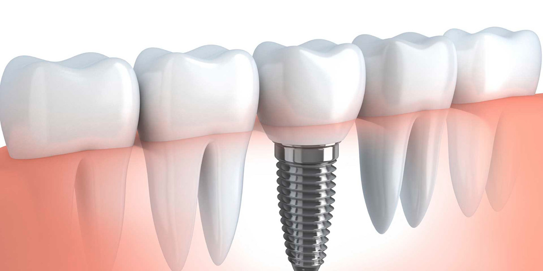 Gli impianti dentali sono una tecnica odontoiatrica che permette la sostituzione di un dente naturale con uno artificiale. Le migliori offerte di impianti dentali si trovano nella clinica di somatologia Gran Turismo Dentale