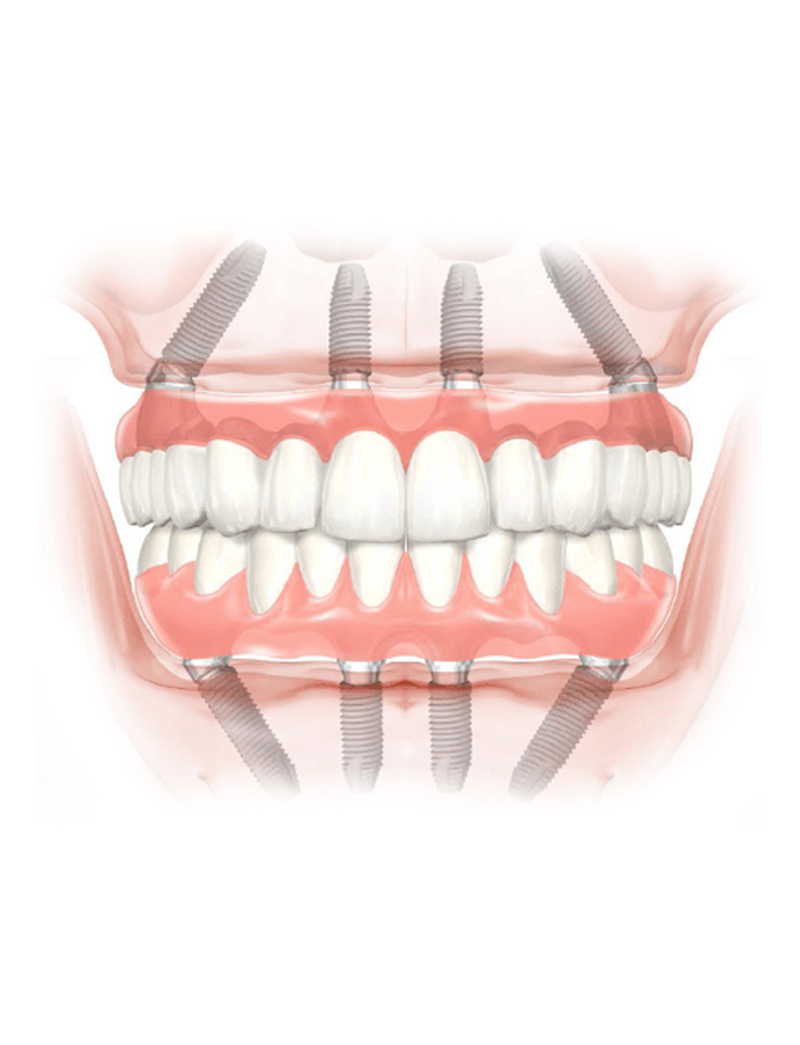 Offerta Impianti Zigomatici con il prezzo di 3 790 € include le seguenti opere e materiali: 2 impianti zigomatici; 2 abutments zigomatici (connessioni protesiche); 12 denti provvisori fisii a carico immediato (denti in resina); Anestesia generale