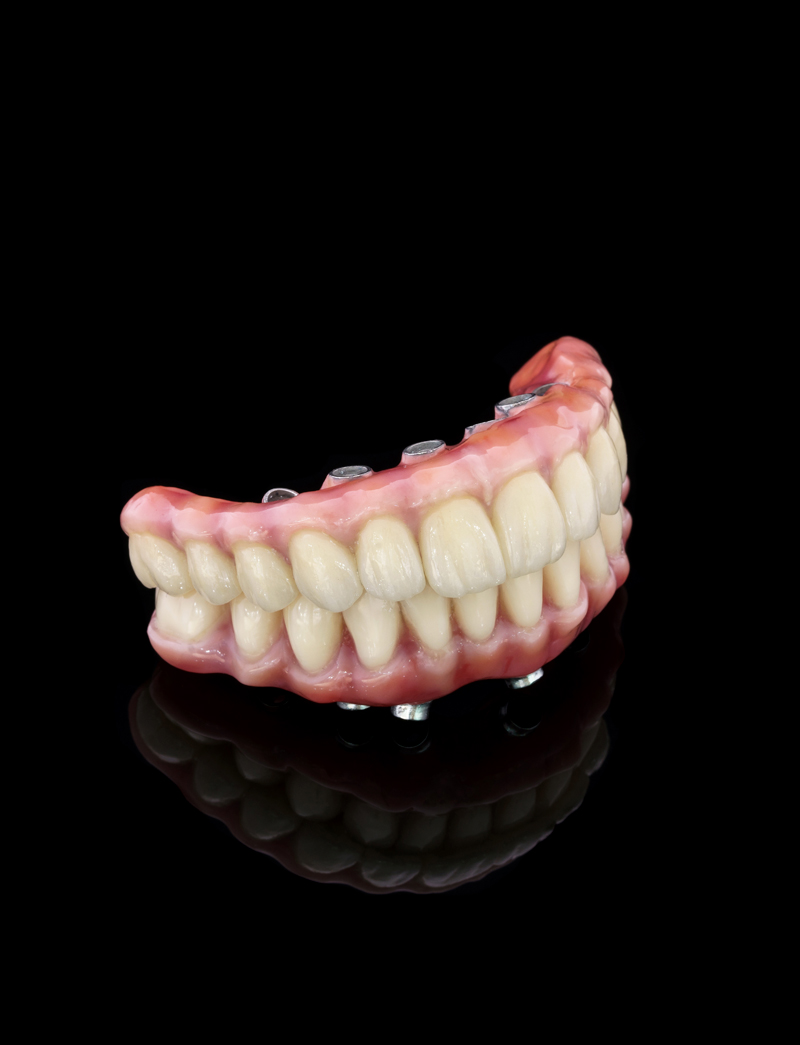 Offerta Impianto All on 6 con il prezzo di 2 540 € include i seguenti lavori e materiali: 6 impianti dentali; 6 abutments; 12 denti provvisori (mobili); 12 corone in resina (denti fissi)
